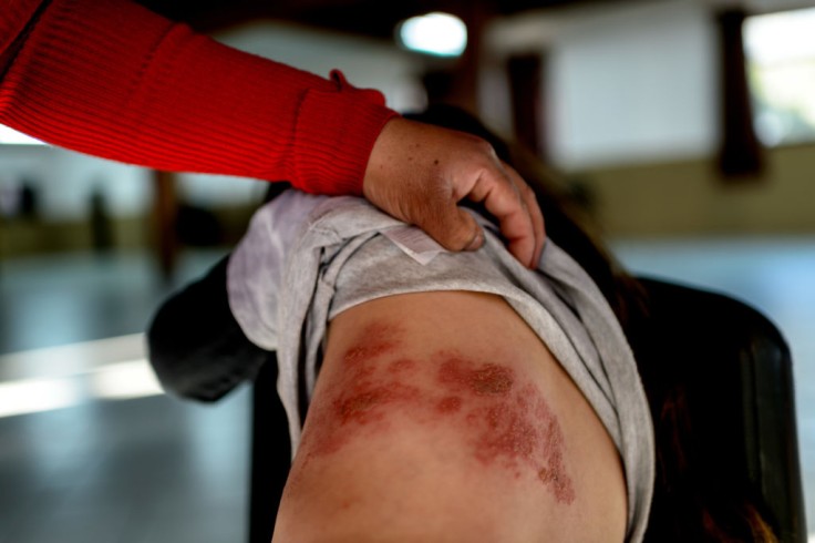 Disney Rash Guide for Parents: Causes, Symptoms, and Cure for this Skin Disease